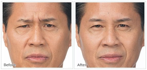 botox2