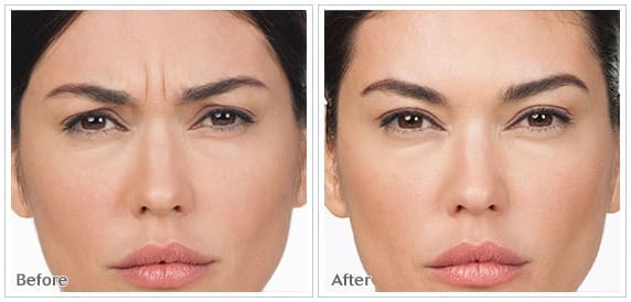 botox8