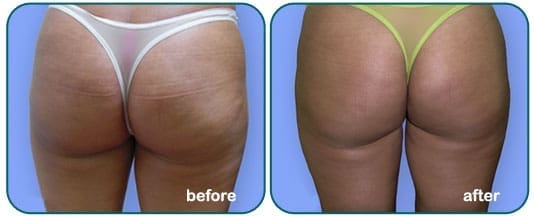 Body Contouring