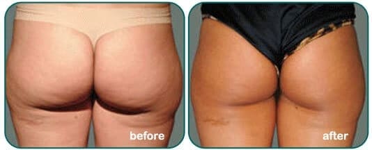 Body Contouring