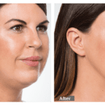 Before And After Image Of Kybella Facial Treatment For Fat Reduction Around The Face With visible Improvement To The Chin Area