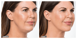 Before And After Image Of Kybella Facial Treatment For Fat Reduction Around The Face With visible Improvement To The Chin Area