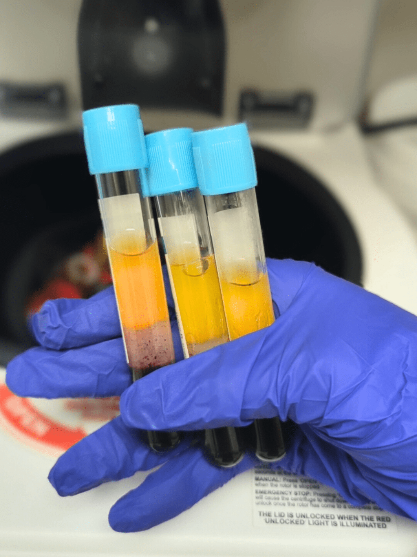 Specialist Holds PRP Vials After Centrifuge Wearing Blue Gloves In preparation For A PRP Hair Loss Treatment