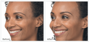 Before And After Skin Smoothing Treatment On A Woman Focused On Brow Wrinkles And Crow Feet With Visible Impreovement