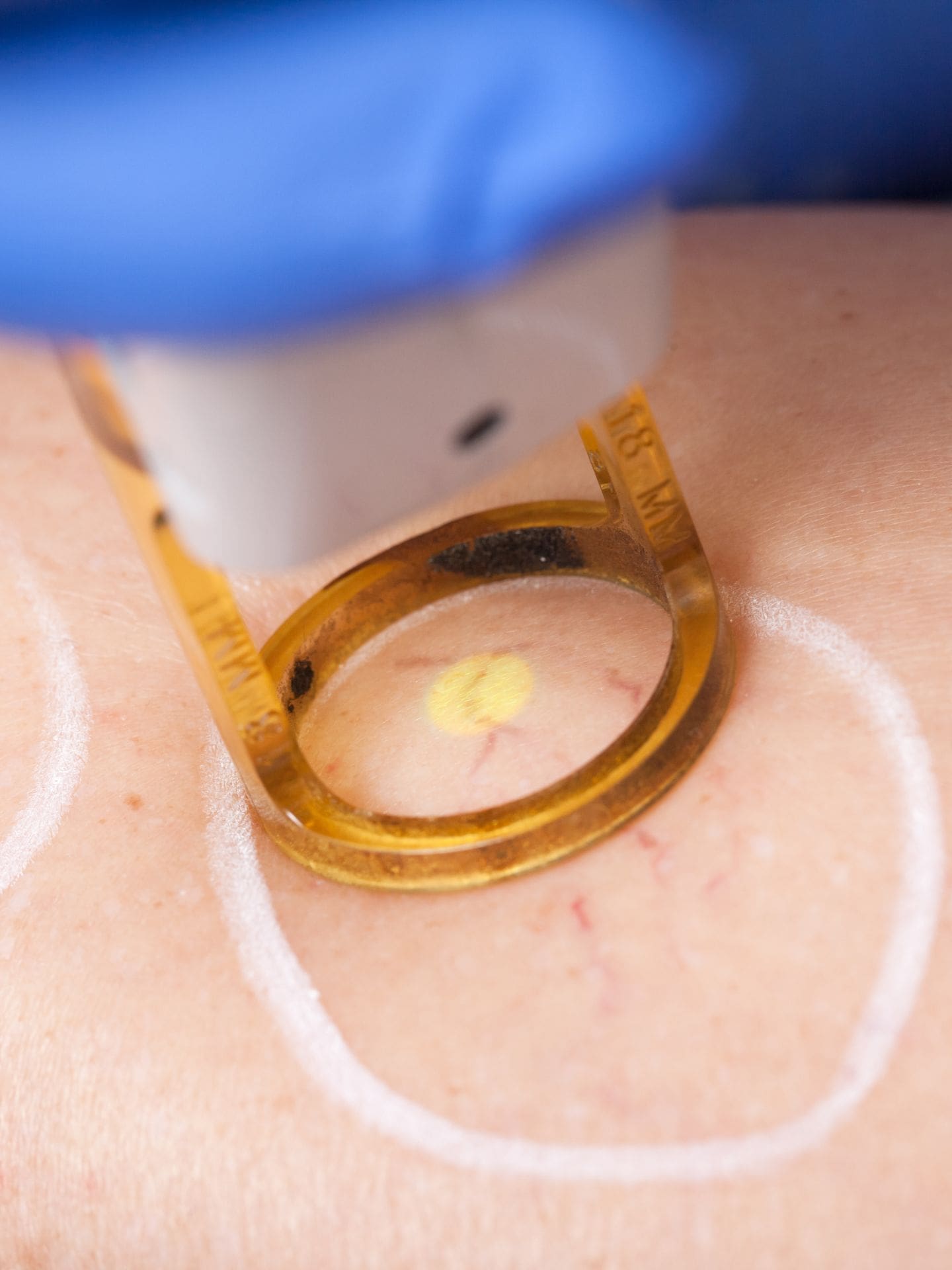 Specialist Applying Sclerotherapy Vein Removal Treatment On Patient Skin With The Areas Of Treatment Marked In White Pencil