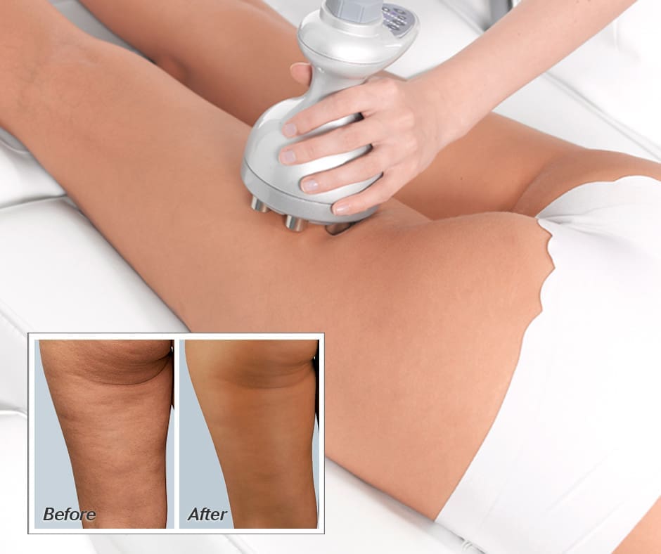 Venus Bliss Cellulite Reduction Body Contour Treatment Before And After Legs Showcase Proving Visible Results