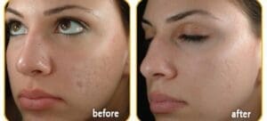 Showcase Of Woman's Face Before And After Facial Treatment For Acne Showing visible Improvement Reducing Acne Scars