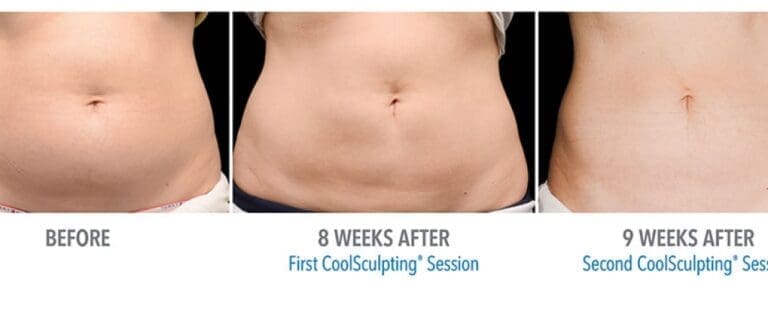 Body Sculpting