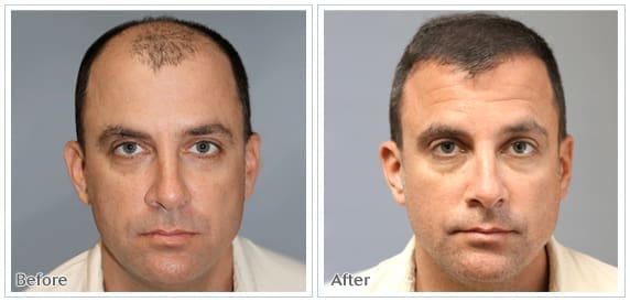 danik-med-spa-surgery-hair-transplantation1