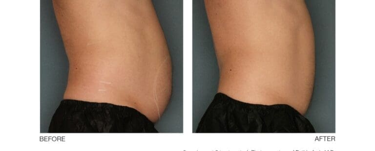 Body Contour
